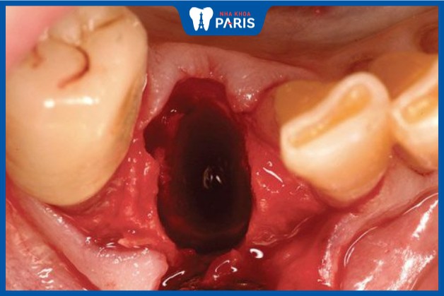 Cục máu đông sau khi nhổ răng: Tác dụng và cách bảo vệ
